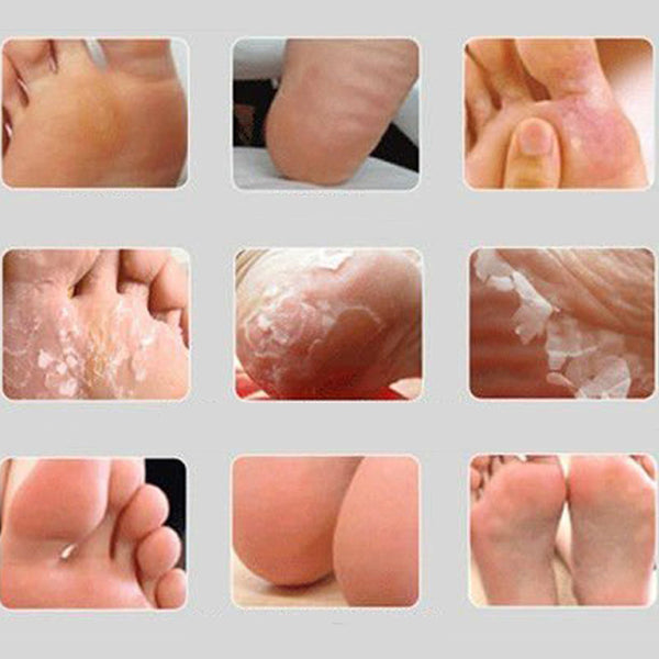 Foot Peel - dead skin removal