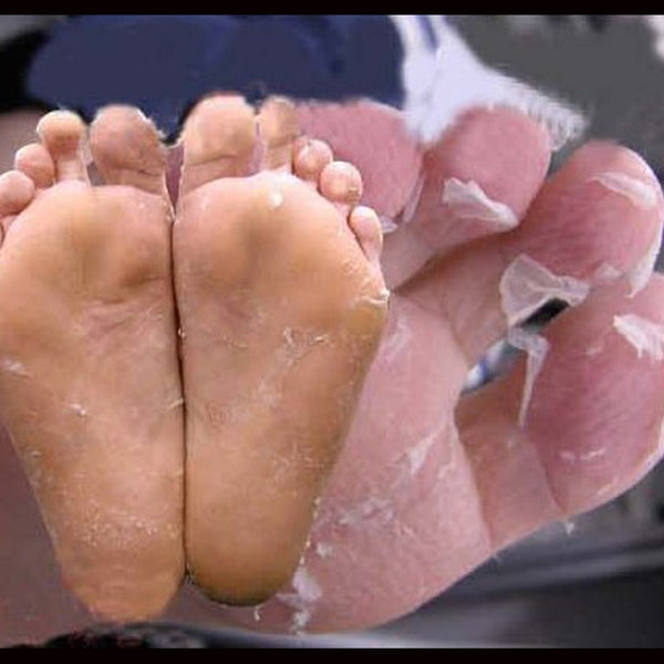 Foot Peel - dead skin removal